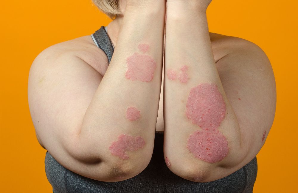 Eczema Relief: Discover the Number One Remedy That Works