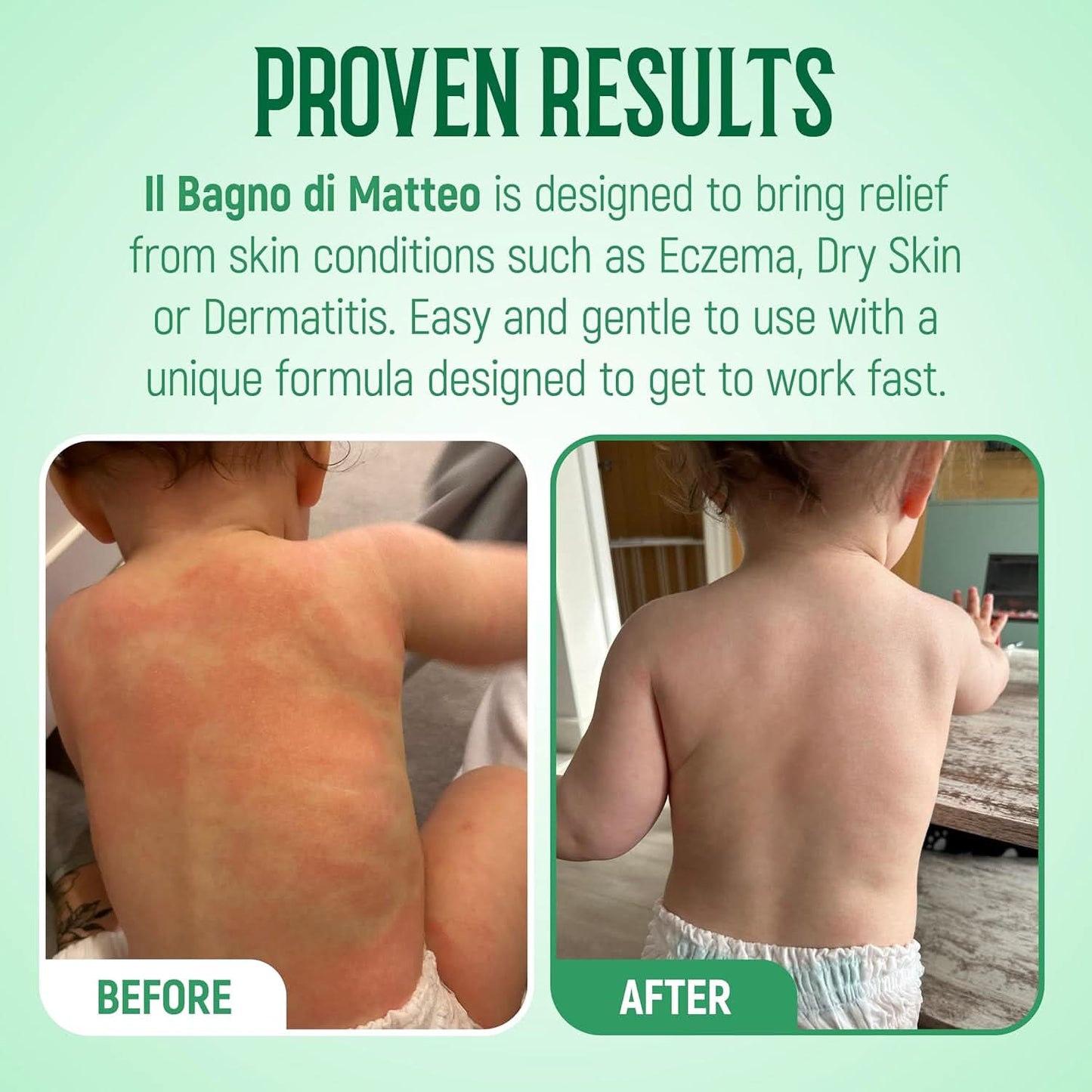 Before and after images of a child's back highlight the effectiveness of 1936 Original's Il Bagno Body Wash for Eczema, Atopic Dermatitis, Psoriasis & Dry Skin. The before photo displays red, irritated skin, whereas the after photo shows clear, smooth skin. The text explains the product's fast-acting itch relief benefits for eczema and dermatitis, thanks to its gentle formulation with 95% natural ingredients.